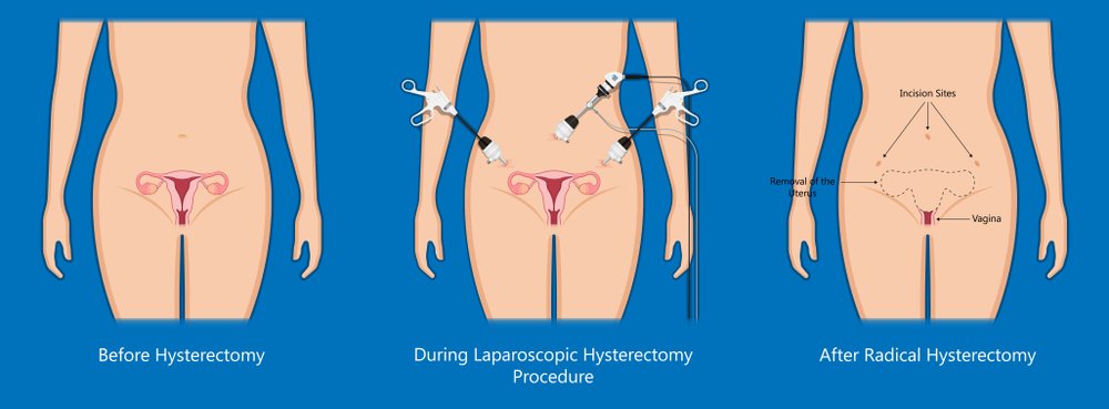 استئصال الرحم Hysterectomy مركز رويال للخصوبة